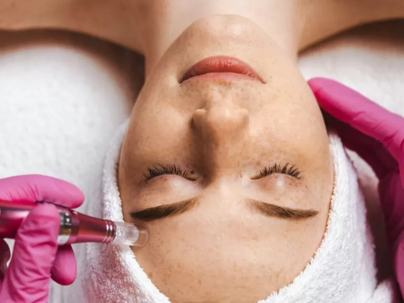 Microagulhamento facial