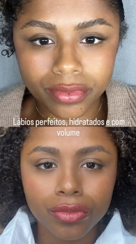 Resultado lábios perfeitos MÍRAME